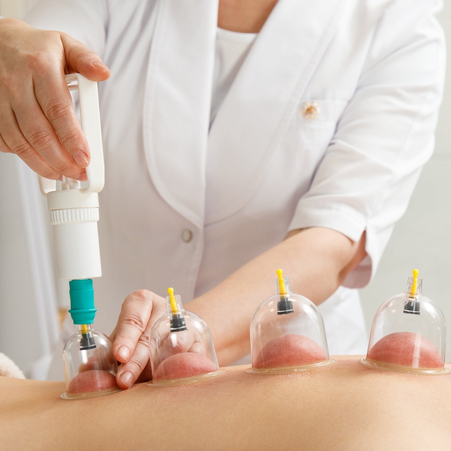 Cupping kit with multiple cups for therapy.