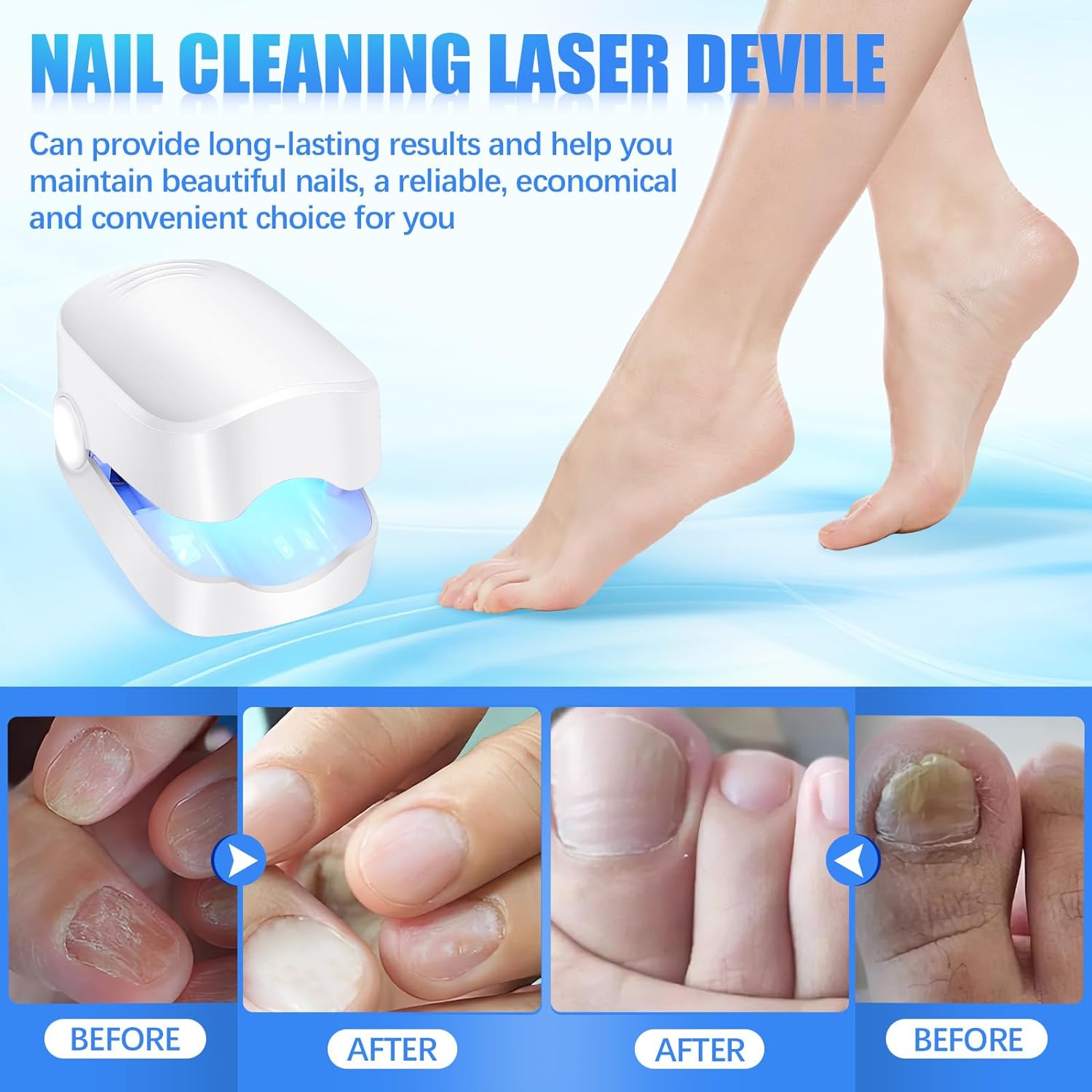 Rechargeable Nail Fungus Treatment for Toenail, Toe Nail Fungal Treatment Nail Fungus Laser Device, Anti-Fungal Nail Treatment for Hand &amp; Feet Infections Remover for Home Use